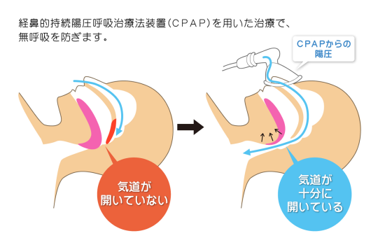 無 呼吸 症候群 マスク